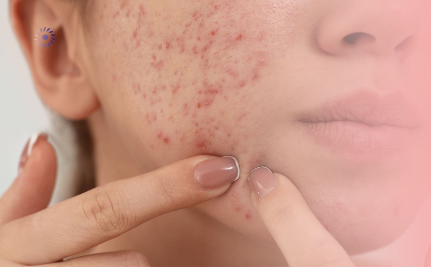 أسباب احمرار الوجه وظهور حبوب أسباب احمرار الوجه وظهور حبوب