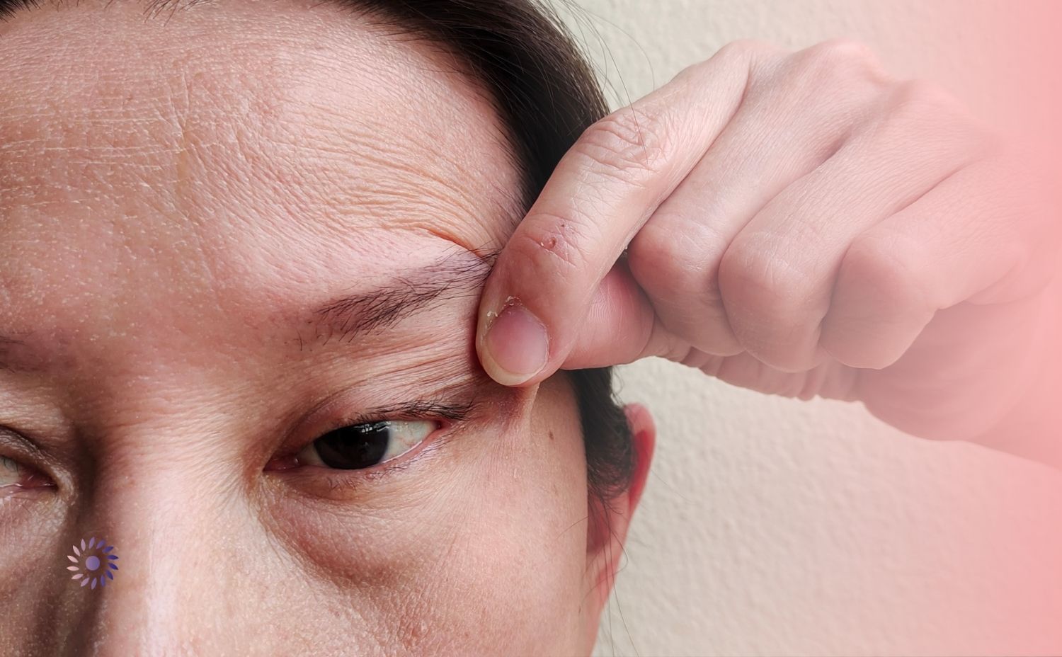 علاج ارتخاء جفن العين البسيط علاج ارتخاء جفن العين البسيط