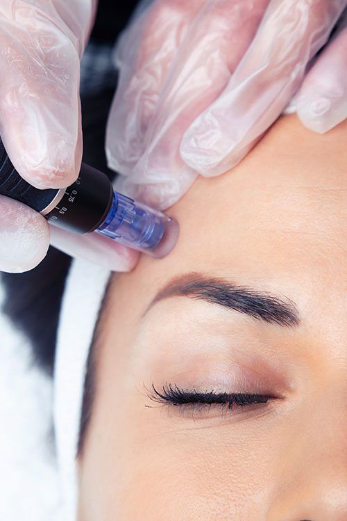 Microneedling und die Heilung danach – Ihre Expertin klärt auf.