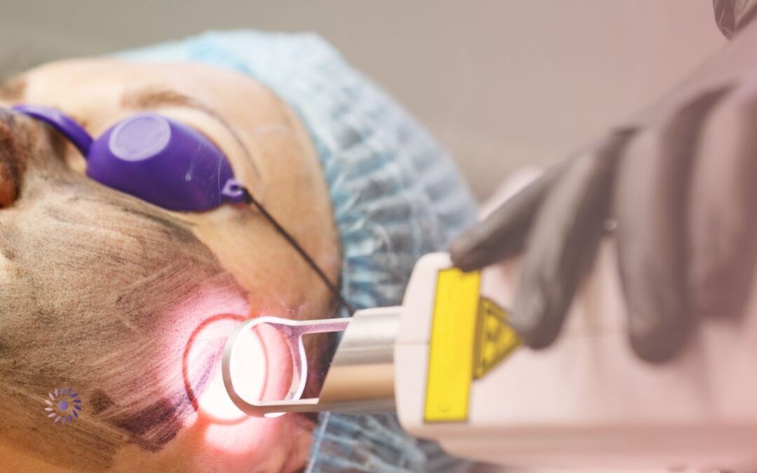 CO2 Laser Faltenbehandlung: Effektive Hautglättung