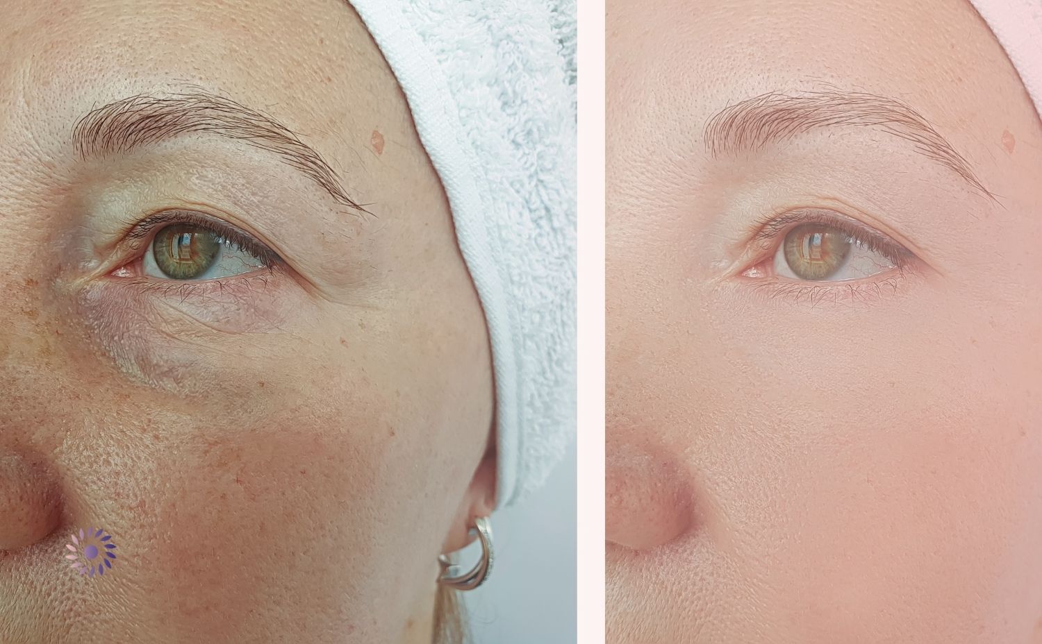 faltenbehandlung Wuppertal faltenbehandlung Wuppertal