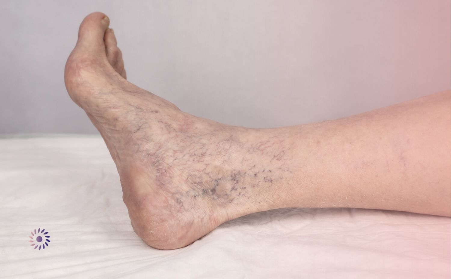 علاج الدوالي علاج الدوالي