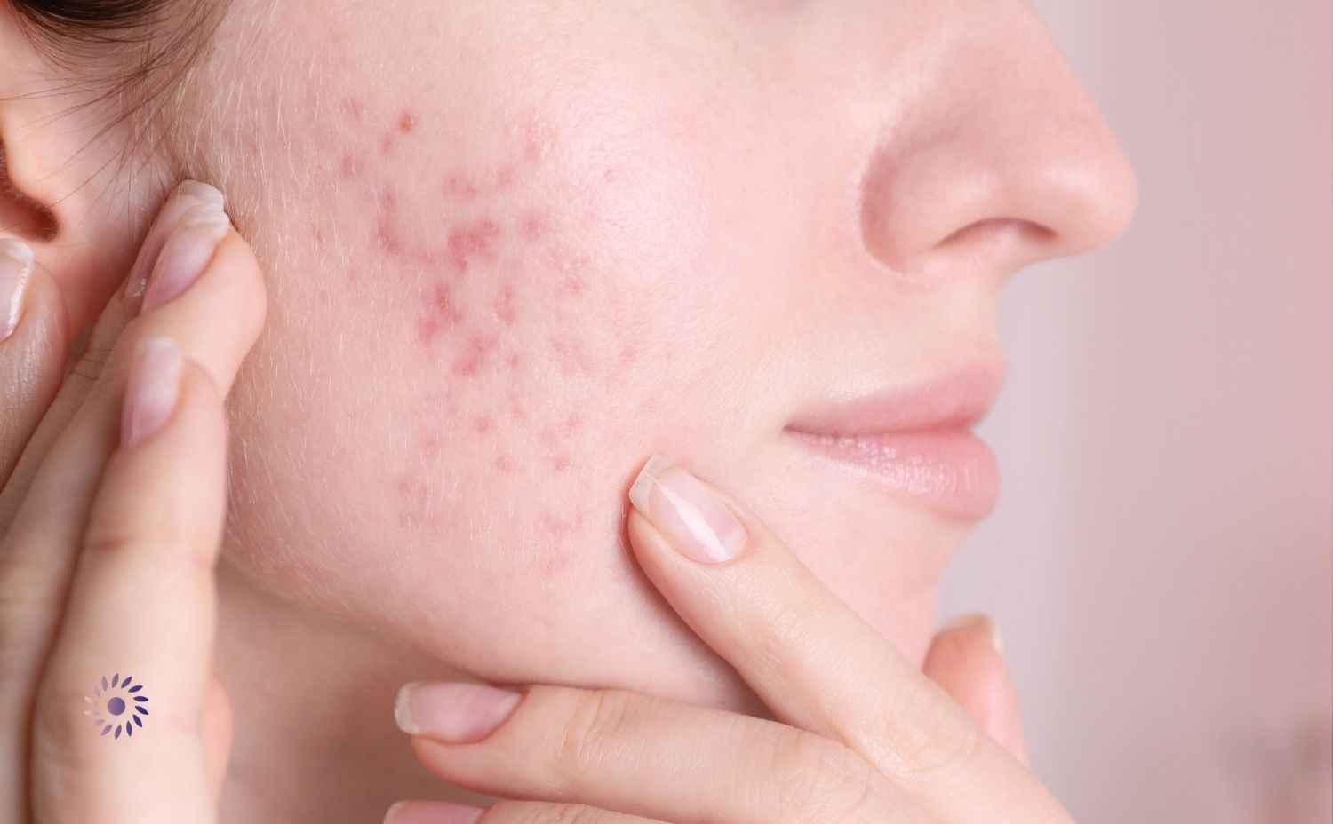 ازالة ندبات الوجه القديمة ازالة ندبات الوجه القديمة