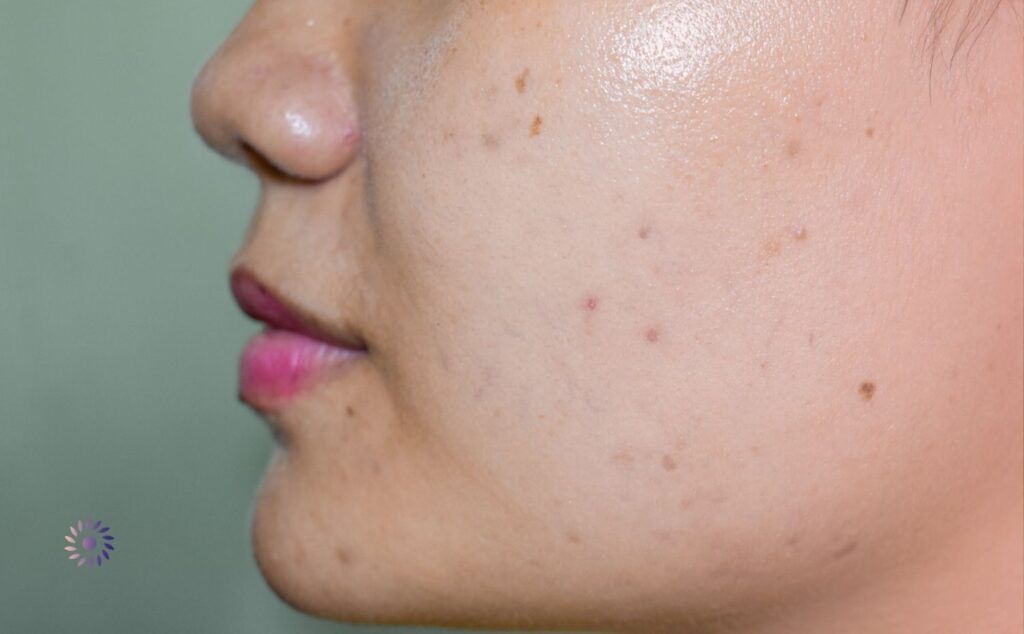 طرق علاج حالة بقع سوداء على الجسم