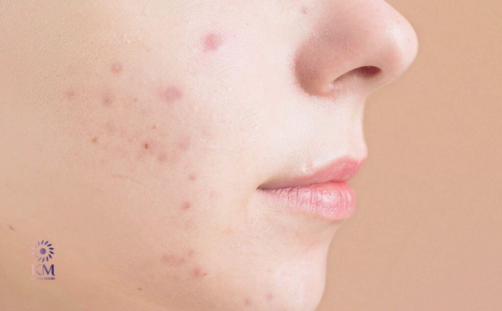 Ist die Laserbehandlung schmerzhaft und gibt es Ausfallzeiten