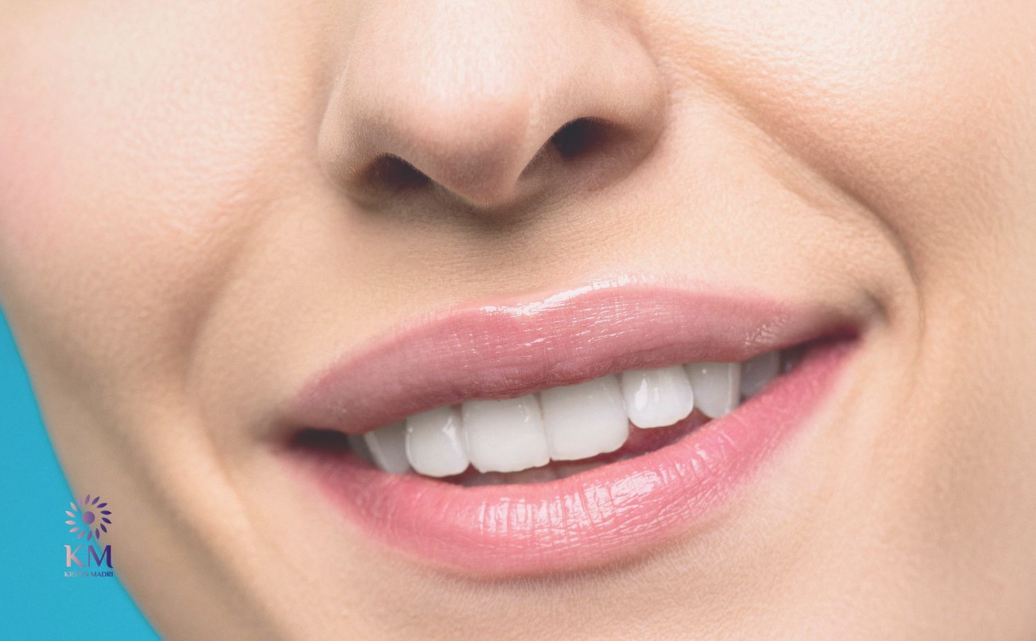 Lippen aufspritzen für natürliches Volumen in der Praxis Dr. Krstin Madri – sicher, sanft und individuell für natürliche Ergebnisse. Jetzt Termin buchen!