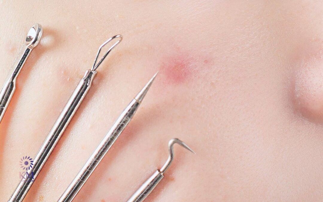 Professionelle Aknenarben Entfernung mit Laser in Wuppertal – Endlich wieder glatte Haut