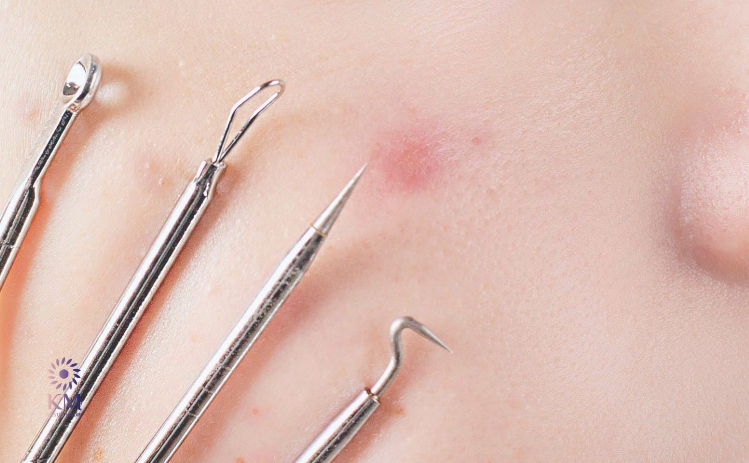 Professionelle Aknenarben Entfernung mit Laser in Wuppertal – Endlich wieder glatte Haut