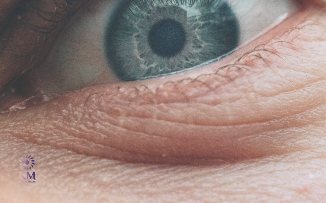 حل مشكلة الجلد الزائد تحت العين | عيادة الدكتورة كرستين مدري