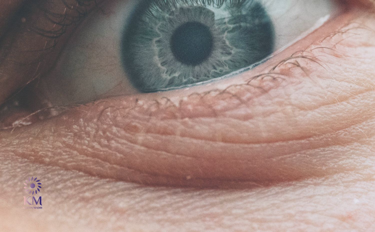 حل مشكلة الجلد الزائد تحت العين عيادة الدكتورة كرستين مدري