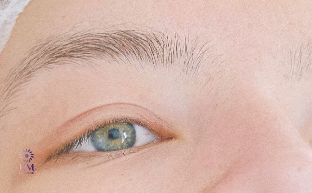 ما هي أفضل استراتيجيات التخلص من انتفاخ الجفون السفلية منزلياً وطبياً؟