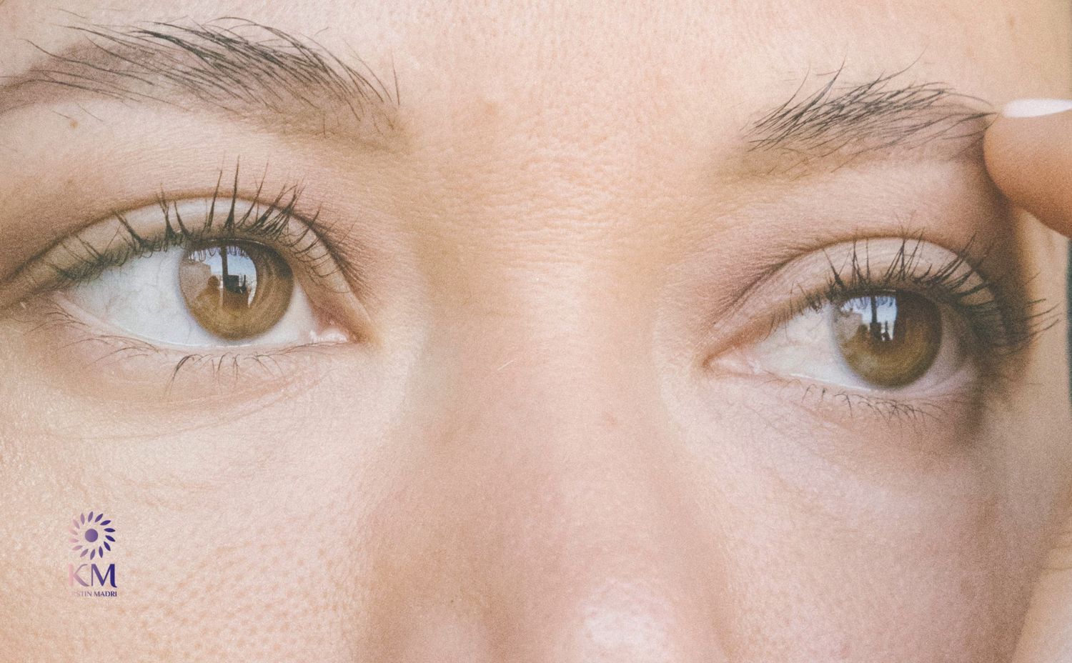 التخلص من ترهل الجفون نهائياً عيادة الدكتورة كرستين مدري