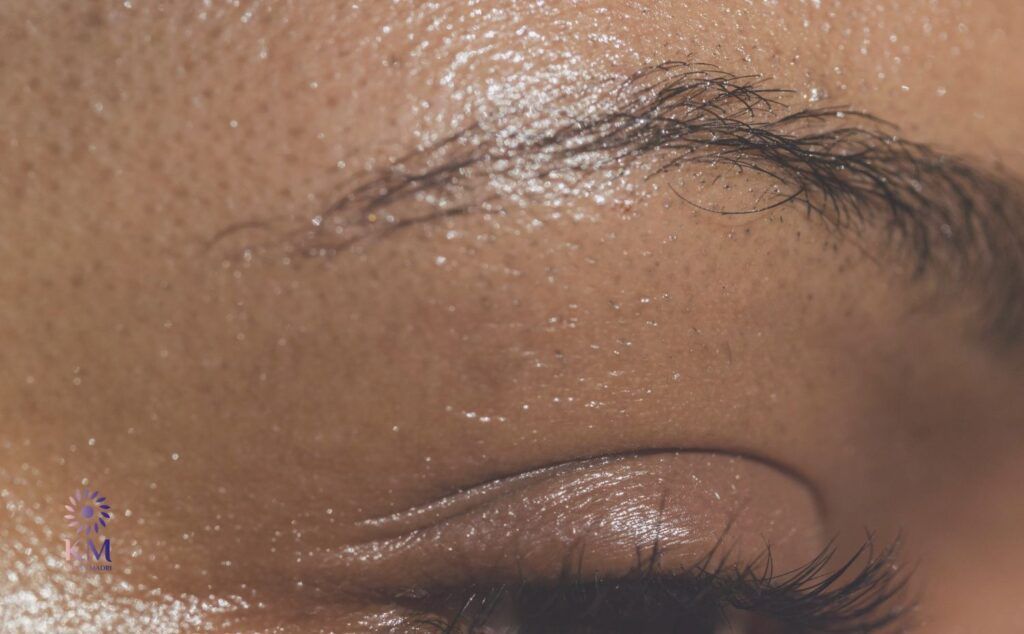 هل يمكن التخلص من ترهل الجفون نهائياً؟