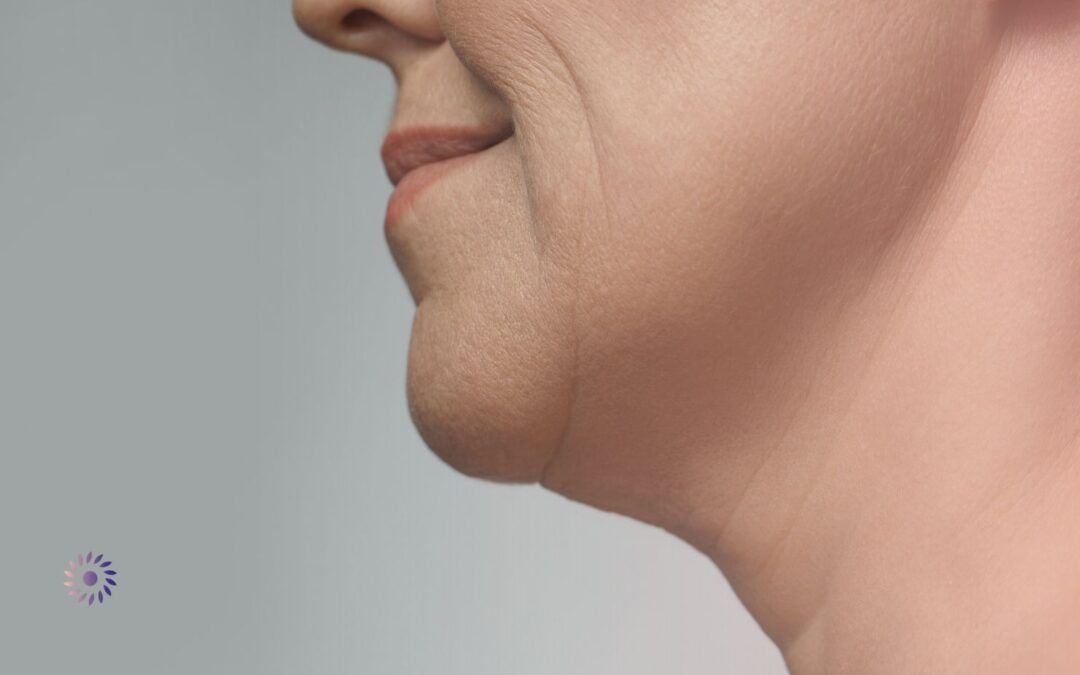 Fadenlifting Hängebäckchen Kosten: Das sollten Sie wissen