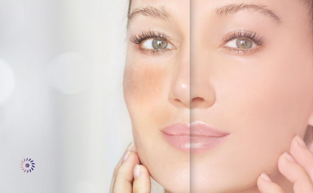 نصائح لتعزيز نتائج إبر النضارة